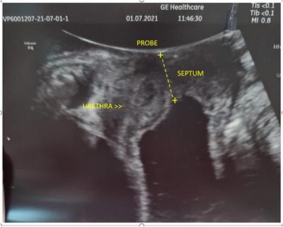 Case report: Hydrometrocolpos conditioning recurrent urinary tract infections